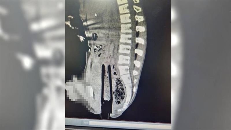 野外跳水不慎遭長竿插入！男下體爆血送醫