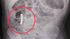 透過X光檢查，發現男童體內疑似有7顆具有強力磁性的巴克球。（圖／輔醫提供）