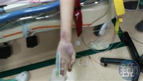 5億男右手臂針孔是醫謢搶救所致？　家屬公布照片求真相