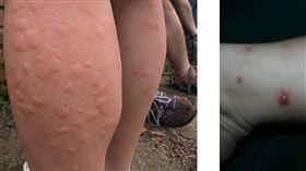 小黑蚊，叮咬，過敏反應，貼片式疫苗，減敏，療效維持10年(圖／台中榮總提供)