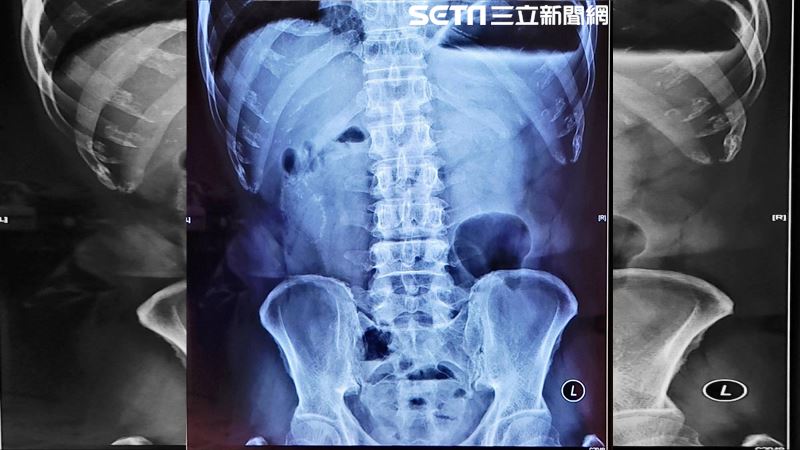高雄男「1天吃3顆」慘了　抱肚子住院6天