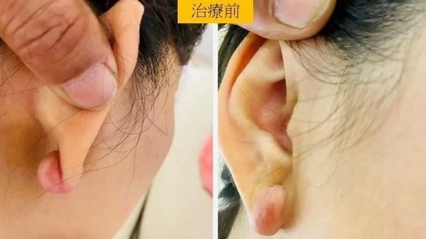 驚!才穿完耳洞 「神祕腫塊」迅速覆蓋