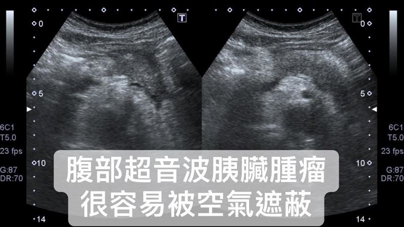 「癌王」胰臟癌早期無症狀？醫師：其實有