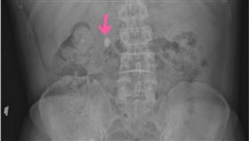 衛福部基隆醫院提供