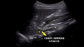 11歲男童，暴瘦，噁心嘔吐，食慾差，罹「上腸繫膜動脈症候群」(圖／中港澄清醫院提供)