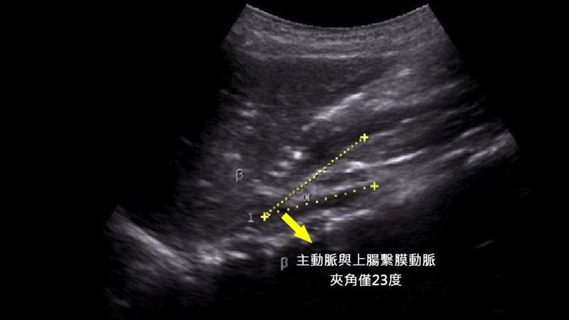 11歲男童「吃就吐」暴瘦　醫曝1器官慘況