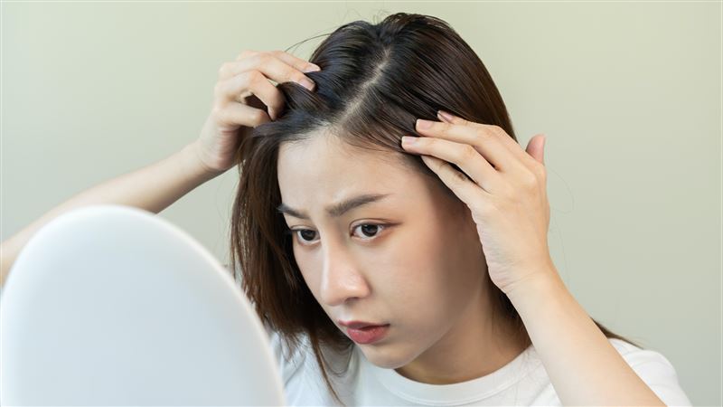 陷脫髮焦慮的韓國青年　脫髮預防商機潛力