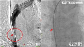 洗腎嬤「水腫像豬頭」支架手術助順利消腫（圖／翻攝畫面）