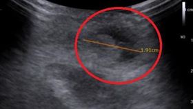 5歲男童，肚子痛，兒童腹股溝疝氣，睪丸腫塊(圖／烏日林新醫院提供)