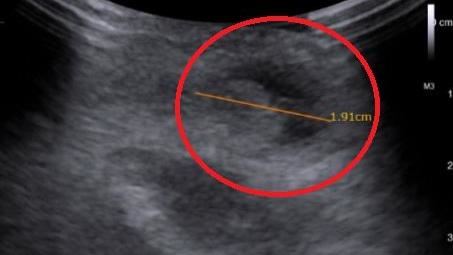 5歲童莫名肚子痛3年 醫一照:2公分腫塊