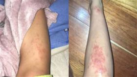 ▲哥倫比亞一名27歲女子日前到海邊度假回來後，突然發現自己的腿部出現莫名紅點，就醫後竟被診斷遭到寄生蟲寄生。（圖／TikTok／doscabraslocas）