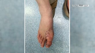 小心毒蛇！南庄露營腳趾疑遭龜殼花咬傷