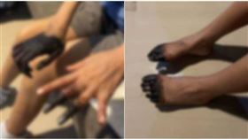 30歲人妻腹瀉就醫...住院9天「手掌、腳趾全發黑」！恐怖下場曝光。（圖／翻攝自sanook）