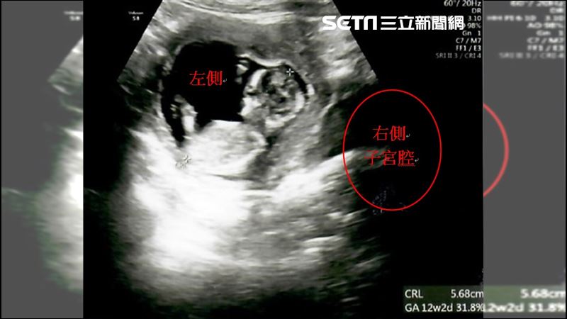 婦多年行房未孕　求醫驚見罕見雙子宮陰道