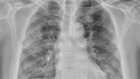 一名70歲染疫長者，染疫後雖立即服用抗病毒藥物，但後續血氧剩下7、80，且X光發現出現重症肺炎，趕緊收治住院。（圖／翻攝自蘇一峰臉書）