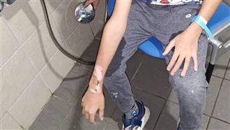 戴智慧手錶爆炸　男童右手臂2度燒燙傷