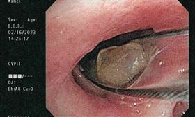 假牙少一顆竟卡在支氣管！嚴重恐釀肺塌陷、壞死，圖／桃園電子報