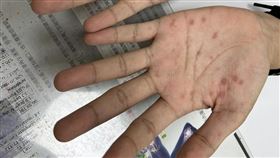 梅毒。（圖／翻攝自臉書理雞先生 ― 泌尿科施冠偉醫師）