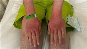 ▲倉鼠；恙蟲病（圖／翻攝自微博）