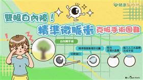 宜蘭陽大附醫引進新式手術－精準微脈衝環形切囊術，完成白內障手術過程中最困難的「撕囊」步驟，讓這名病患獲得良好的術後成果