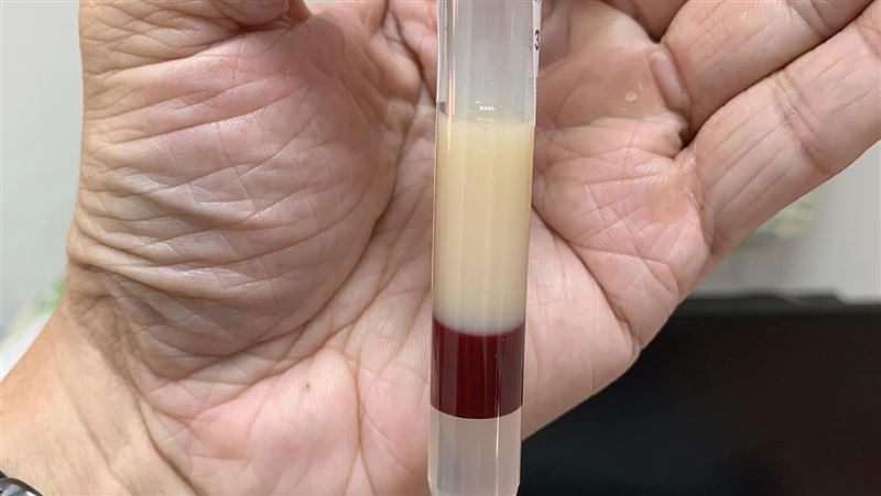 醫曬「結凍豬油」血液:別吃太油!網嚇壞