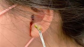 陳思齊使用盯聹鉗取出蟋蟀。（圖／聯新國際醫院提供）