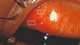 ▲土耳其10歲男童因為眼睛痛就診，經檢查竟發現有活蛆寄生眼中。（圖／翻攝自推特@habertip）