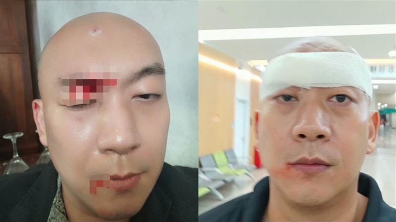 男星被燈砸中險失明　爆血驚悚畫面曝光
