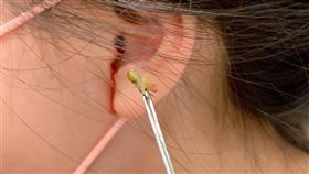 陳思齊醫師使用盯聹鉗取出蟋蟀。（圖／聯新國際醫院提供）