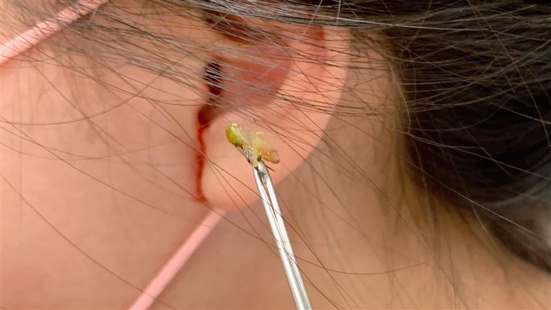 女童耳朵痛喊蟲翅膀動 醫:耳道血肉模糊