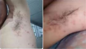 工人,濕疹,主管,噁心,離職