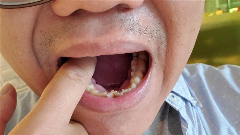 口腔有淋病細菌？醫示警：恐成性病大禮包