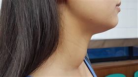 一名28歲的李小姐已經與右頸的甲狀腺良性腫瘤和平共處長達10年。（圖非新聞當事人／馬偕醫院提供）