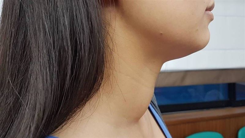 脖子摸到「硬硬的東西」　揭密甲狀腺癌