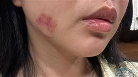 ▲受害女被打到全身都是傷，臉部也留下明顯瘀傷。（讀者提供）