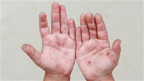 每週萬人感染腸病毒　醫師籲：勤洗手保健康（業配勿用）