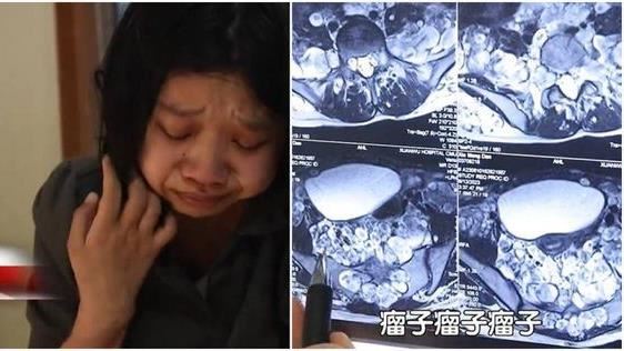 22歲女長上千顆腫瘤　醫：會在痛苦中死去