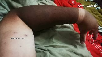 烈陽曝曬「手臂黑如炭」　醫：當心皮膚癌