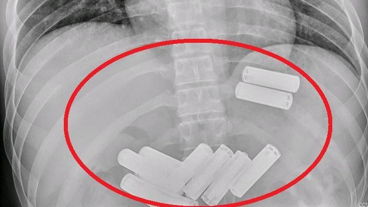 23歲男吞11顆電池！耗費1小時胃鏡取出