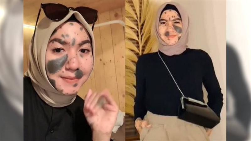 她滿臉胎記受盡嘲笑　被逼分手理由好傷人