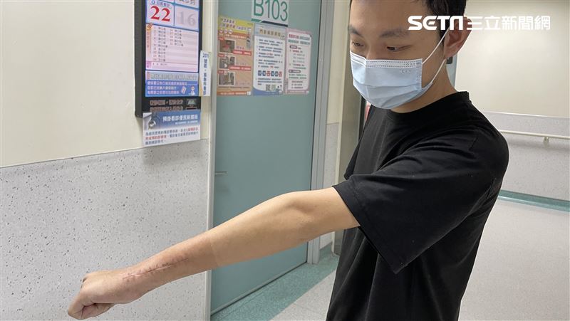 他拿水杯也吃力　竟是罹患「骨巨細胞瘤」