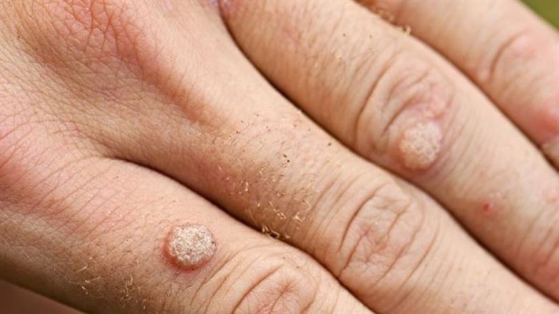 染上菜花同家族病毒…發癢一抓　爆出60顆