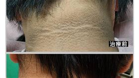 醫師指出破百公斤國中生胖到後頸出現黑色斑紋。（圖／光田醫院授權提供）