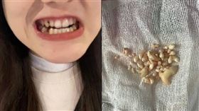 23歲嫩妹「一次拔57顆牙」！診出罕見病例醫驚呆：所有實習生都來看 ctwant