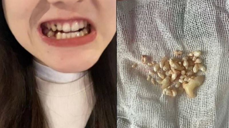 嫩妹「一次拔57顆牙」！醫嚇傻：非常嚴重