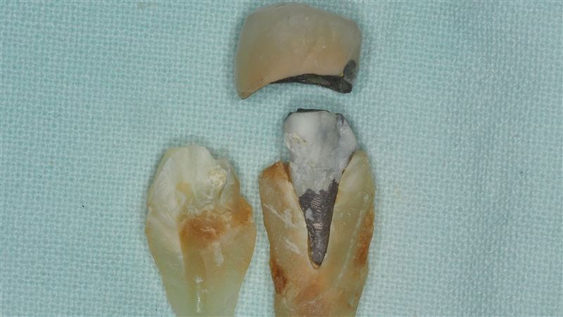 啪一聲!牙咬斷了 一情況牙齒沒救了
