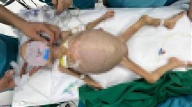 中國一名2歲女童罹患「兒童癌王」神經母細胞腫瘤，肚子膨脹像快爆炸的氣球。（圖／翻攝自搜狐健康）