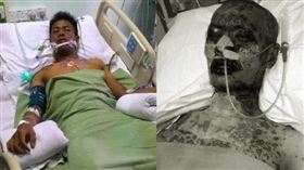 ▲對眼藥水過敏的男子一度命危被送醫搶救。（圖／翻攝自當事人臉書）