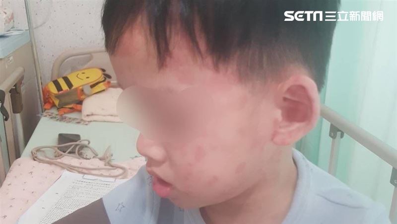 4歲童全身塊狀紅疹　竟是黴漿菌感染惹禍