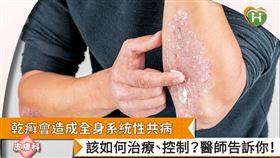 乾癬除了皮膚之外，還會影響到指甲、關節等，甚至合併產生高血壓、糖尿病、心臟病、中風、白斑、腸躁症等系統性共病。